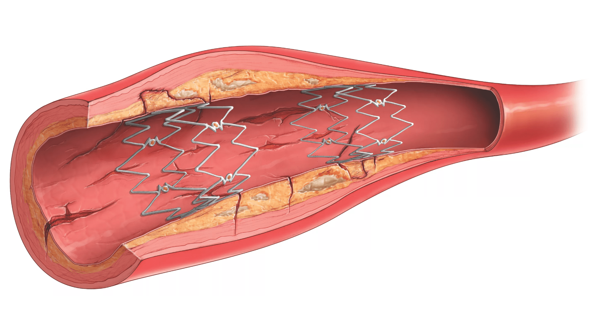 DeviceMD Tack endovascular system